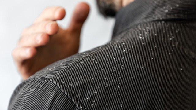 Dá para se livrar da caspa? Veja essas dicas!