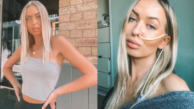 Vacterl: Anomalia fez modelo nascer com duas vaginas