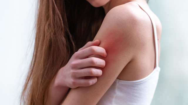 Saiba o que fazer para aliviar uma picada de mosquito