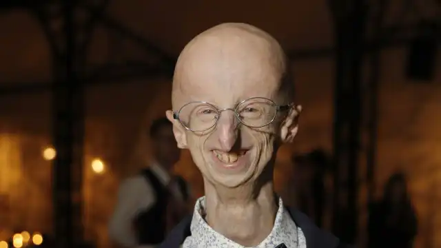 Morreu Sammy Basso, o jovem mais velho com doença rara genética