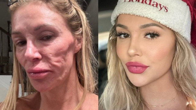 Ex-modelo que teve rosto derretido revela que perdeu 5 dentes