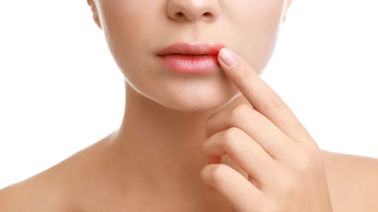 Herpes labial pode aumentar risco de Alzheimer, indica pesquisa