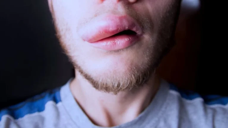 Mais de 1,2 mil pessoas têm reação a pasta Colgate; venda segue proibida