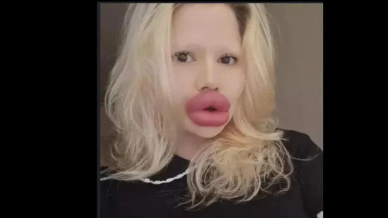 Influenciadora com maiores lábios do mundo é recusada por dentistas