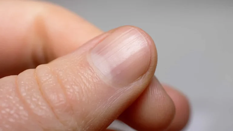 Alerta: dermatologista revela o que podem significar riscos nas unhas