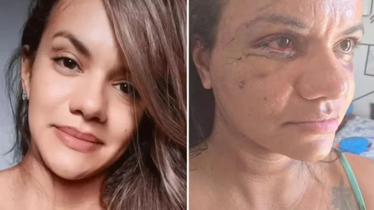 Agredida com 61 socos pelo ex-jogador mostra rosto dias após cirurgia