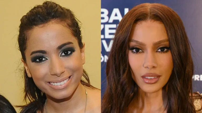 Antes e depois das cirurgias plásticas dos famosos: Os procedimentos que eles fizeram!