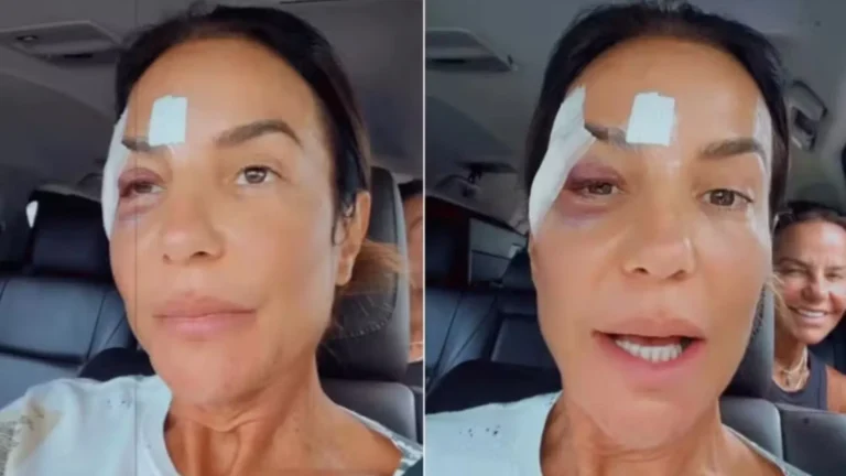 Ivete Sangalo deixa hospital com olho roxo e tranquiliza fãs